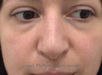 Non-Surgical Rhinoplasty / Nose Filler Before & After Gallery - Patient 146661 - Image 1