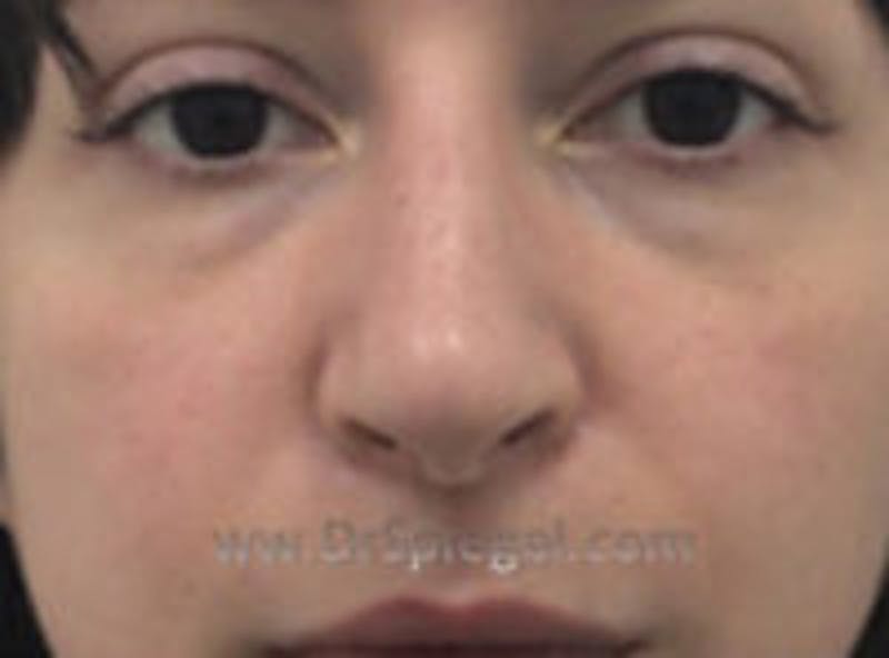 Non-Surgical Rhinoplasty / Nose Filler Before & After Gallery - Patient 146661 - Image 2