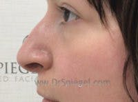 Non-Surgical Rhinoplasty / Nose Filler Before & After Gallery - Patient 146661 - Image 3