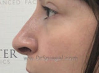 Non-Surgical Rhinoplasty / Nose Filler Before & After Gallery - Patient 146661 - Image 4