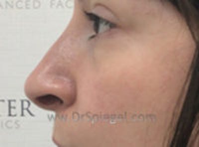 Non-Surgical Rhinoplasty / Nose Filler Before & After Gallery - Patient 146661 - Image 4