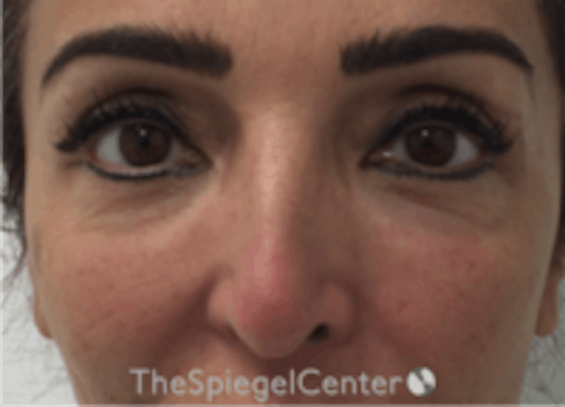 Non-Surgical Rhinoplasty / Nose Filler Before & After Gallery - Patient 293598 - Image 1
