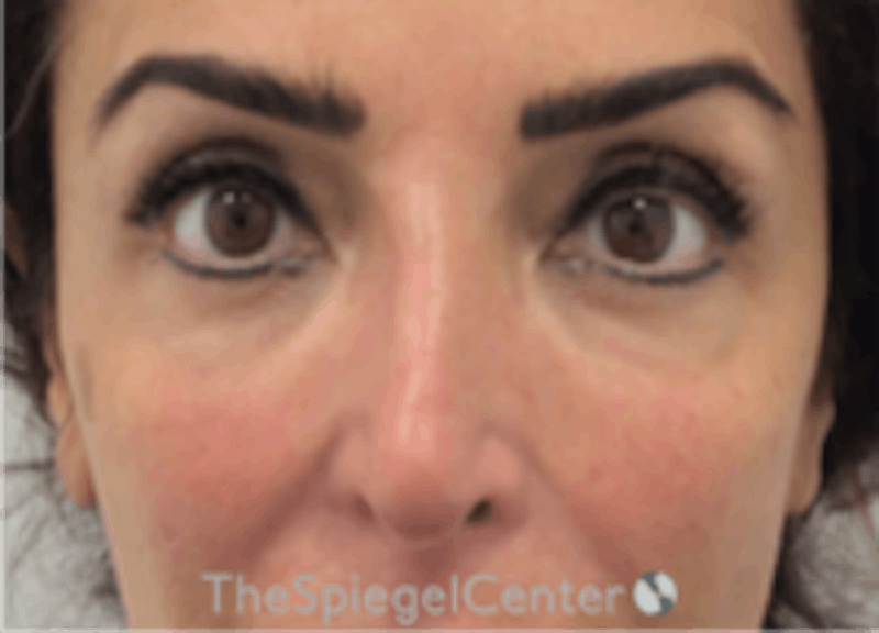 Non-Surgical Rhinoplasty / Nose Filler Before & After Gallery - Patient 293598 - Image 2