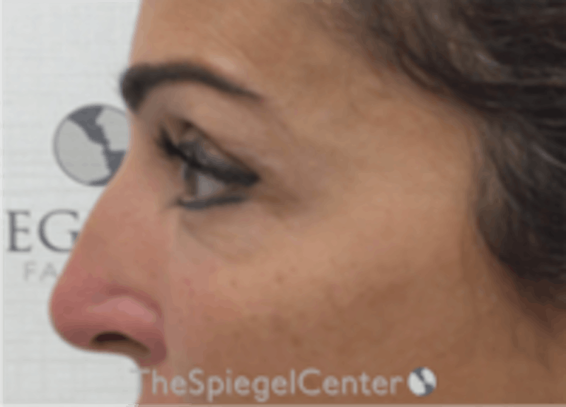 Non-Surgical Rhinoplasty / Nose Filler Before & After Gallery - Patient 293598 - Image 3