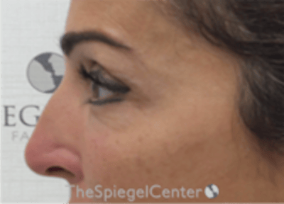 Non-Surgical Rhinoplasty / Nose Filler Before & After Gallery - Patient 293598 - Image 3