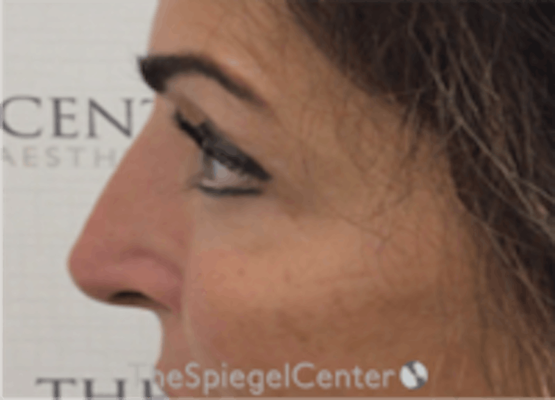 Non-Surgical Rhinoplasty / Nose Filler Before & After Gallery - Patient 293598 - Image 4