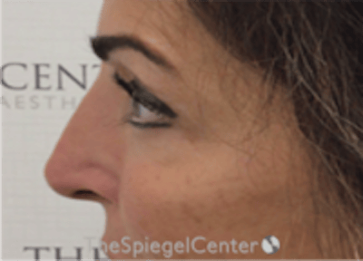 Non-Surgical Rhinoplasty / Nose Filler Before & After Gallery - Patient 293598 - Image 4