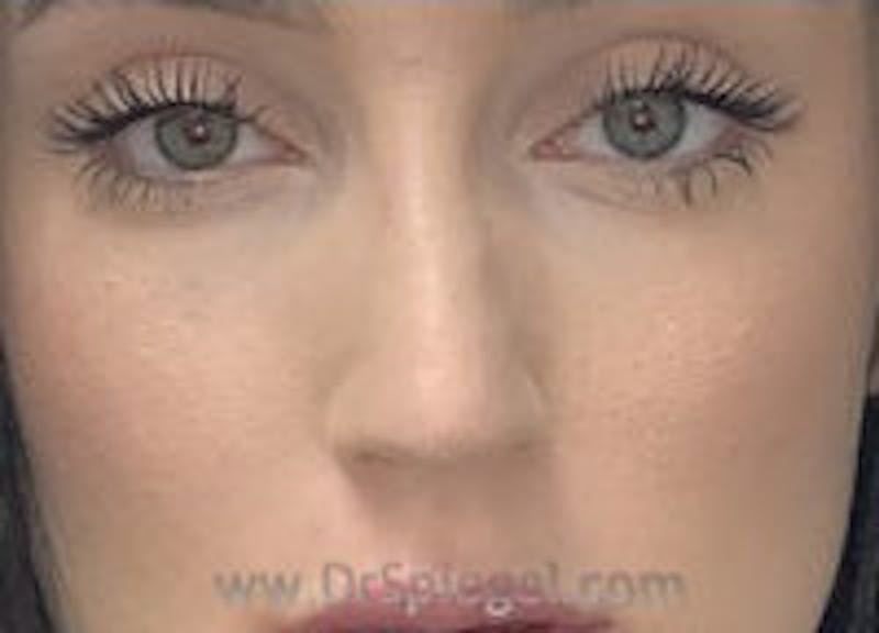 Non-Surgical Rhinoplasty / Nose Filler Before & After Gallery - Patient 756204 - Image 1