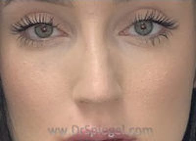 Non-Surgical Rhinoplasty / Nose Filler Before & After Gallery - Patient 756204 - Image 1
