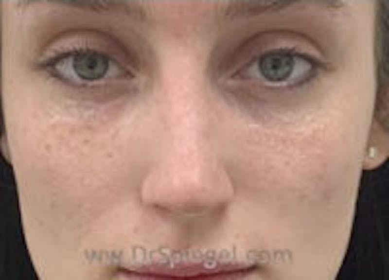 Non-Surgical Rhinoplasty / Nose Filler Before & After Gallery - Patient 756204 - Image 2