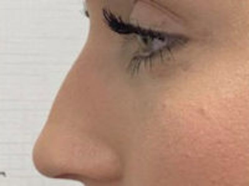 Non-Surgical Rhinoplasty / Nose Filler Before & After Gallery - Patient 756204 - Image 3