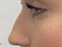 Non-Surgical Rhinoplasty / Nose Filler Before & After Gallery - Patient 756204 - Image 3