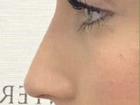 Non-Surgical Rhinoplasty / Nose Filler Before & After Gallery - Patient 756204 - Image 4