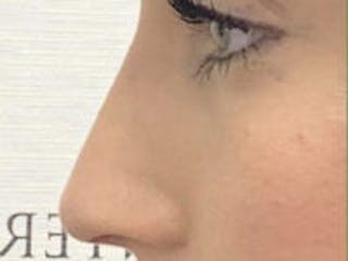 Non-Surgical Rhinoplasty / Nose Filler Before & After Gallery - Patient 756204 - Image 4