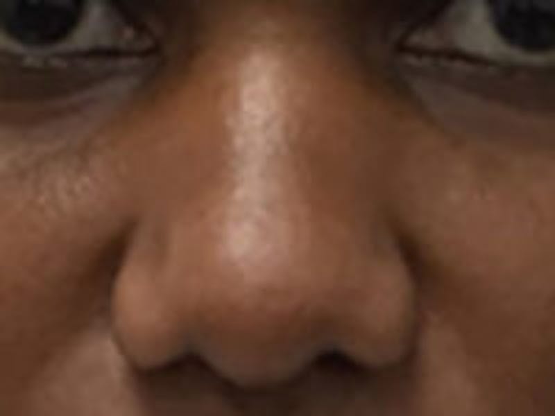 Non-Surgical Rhinoplasty / Nose Filler Before & After Gallery - Patient 284846 - Image 1