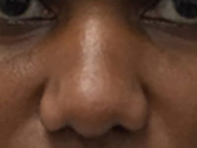 Non-Surgical Rhinoplasty / Nose Filler Before & After Gallery - Patient 284846 - Image 1