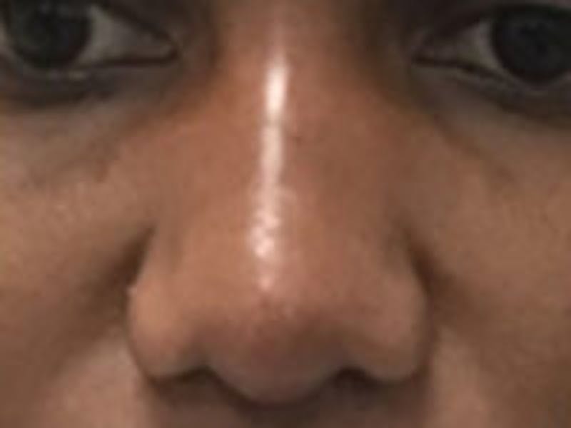 Non-Surgical Rhinoplasty / Nose Filler Before & After Gallery - Patient 284846 - Image 2