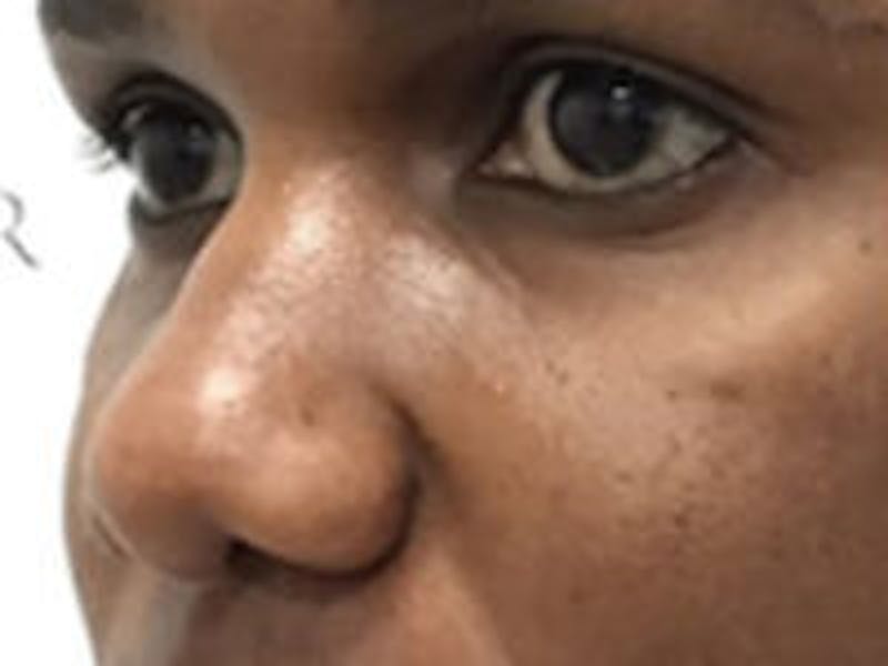 Non-Surgical Rhinoplasty / Nose Filler Before & After Gallery - Patient 284846 - Image 3