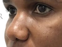 Non-Surgical Rhinoplasty / Nose Filler Before & After Gallery - Patient 284846 - Image 3