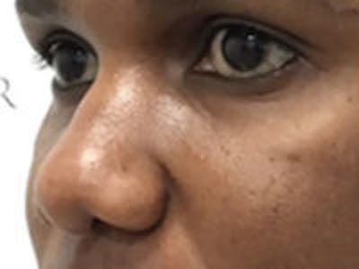 Non-Surgical Rhinoplasty / Nose Filler Before & After Gallery - Patient 284846 - Image 3