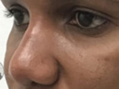 Non-Surgical Rhinoplasty / Nose Filler Before & After Gallery - Patient 284846 - Image 4