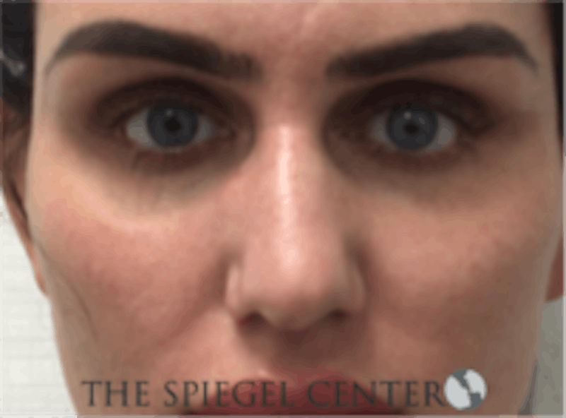 Non-Surgical Rhinoplasty / Nose Filler Before & After Gallery - Patient 707066 - Image 1