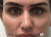 Non-Surgical Rhinoplasty / Nose Filler Before & After Gallery - Patient 707066 - Image 1