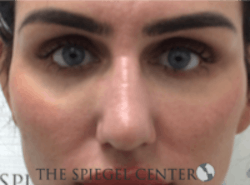 Non-Surgical Rhinoplasty / Nose Filler Before & After Gallery - Patient 707066 - Image 2