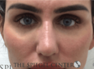 Non-Surgical Rhinoplasty / Nose Filler Before & After Gallery - Patient 707066 - Image 2