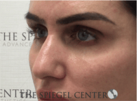 Non-Surgical Rhinoplasty / Nose Filler Before & After Gallery - Patient 707066 - Image 3