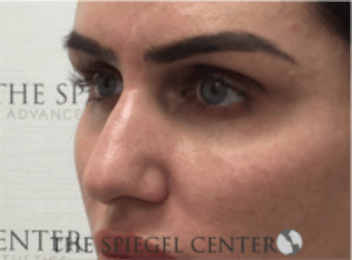 Non-Surgical Rhinoplasty / Nose Filler Before & After Gallery - Patient 707066 - Image 3
