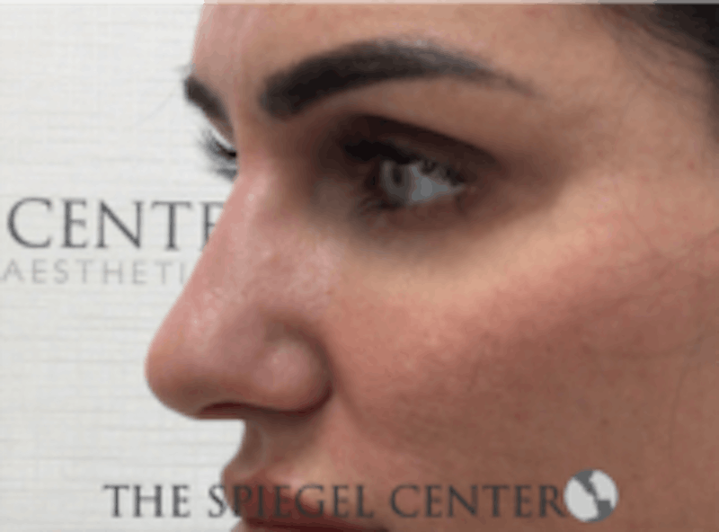 Non-Surgical Rhinoplasty / Nose Filler Before & After Gallery - Patient 707066 - Image 4