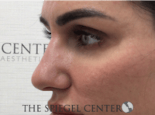 Non-Surgical Rhinoplasty / Nose Filler Before & After Gallery - Patient 707066 - Image 4