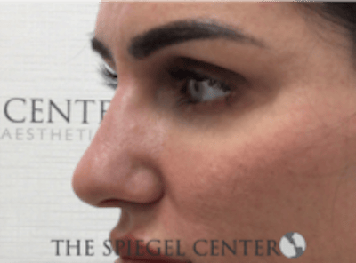 Non-Surgical Rhinoplasty / Nose Filler Before & After Gallery - Patient 707066 - Image 4