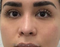 Non-Surgical Rhinoplasty / Nose Filler Before & After Gallery - Patient 337577 - Image 2