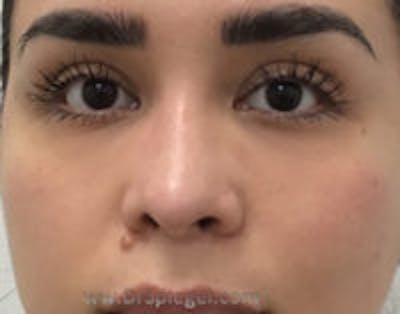 Non-Surgical Rhinoplasty / Nose Filler Before & After Gallery - Patient 337577 - Image 2