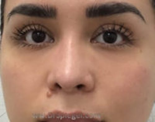 Non-Surgical Rhinoplasty / Nose Filler Before & After Gallery - Patient 337577 - Image 2