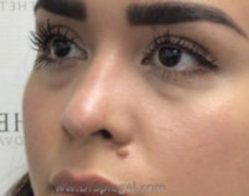 Non-Surgical Rhinoplasty / Nose Filler Before & After Gallery - Patient 337577 - Image 3