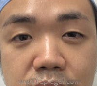 Non-Surgical Rhinoplasty Before & After Gallery - Patient 161454 - Image 1
