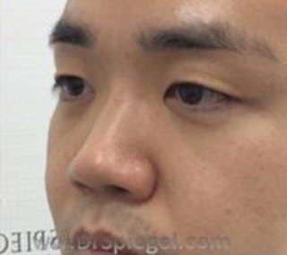 Non-Surgical Rhinoplasty / Nose Filler Before & After Gallery - Patient 252340 - Image 4