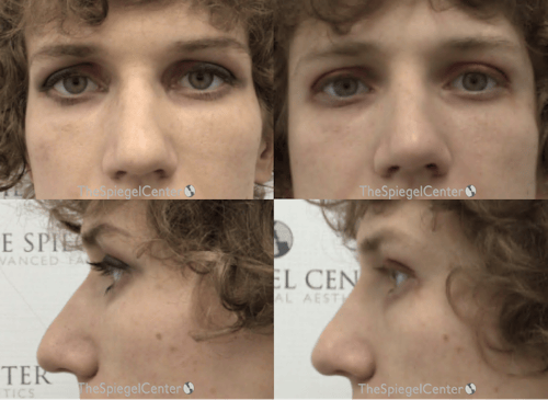 Non-Surgical Rhinoplasty / Nose Filler Before & After Gallery - Patient 306623 - Image 1