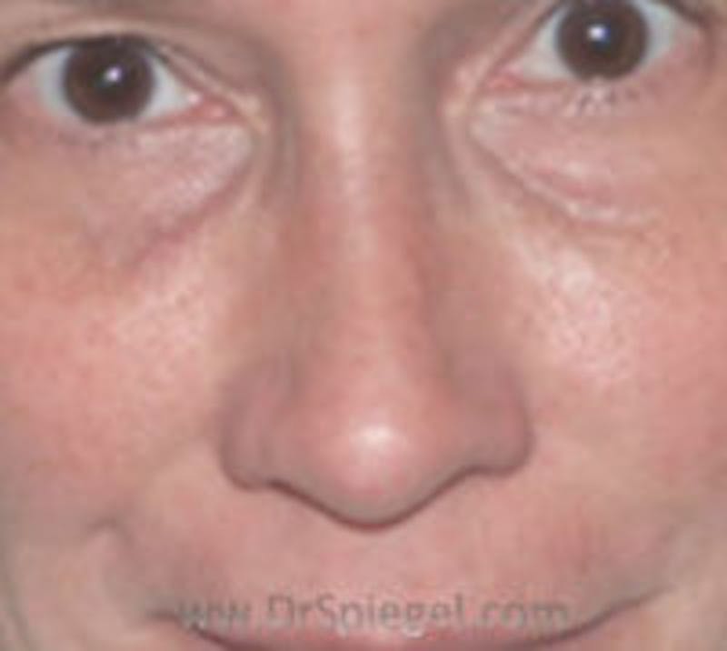 Non-Surgical Rhinoplasty / Nose Filler Before & After Gallery - Patient 200619 - Image 1