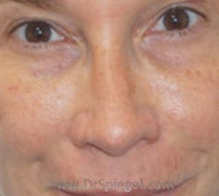 Non-Surgical Rhinoplasty / Nose Filler Before & After Gallery - Patient 200619 - Image 2