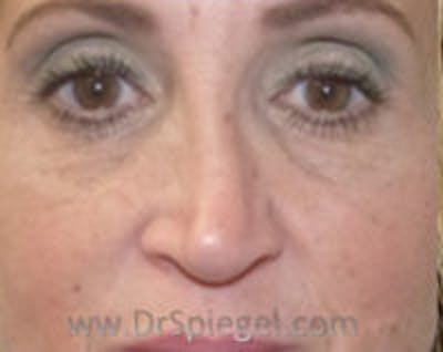 Non-Surgical Rhinoplasty / Nose Filler Before & After Gallery - Patient 132383 - Image 1