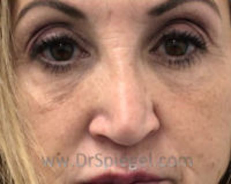Non-Surgical Rhinoplasty / Nose Filler Before & After Gallery - Patient 132383 - Image 2