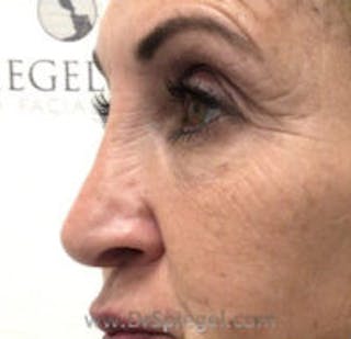 Non-Surgical Rhinoplasty / Nose Filler Before & After Gallery - Patient 132383 - Image 4