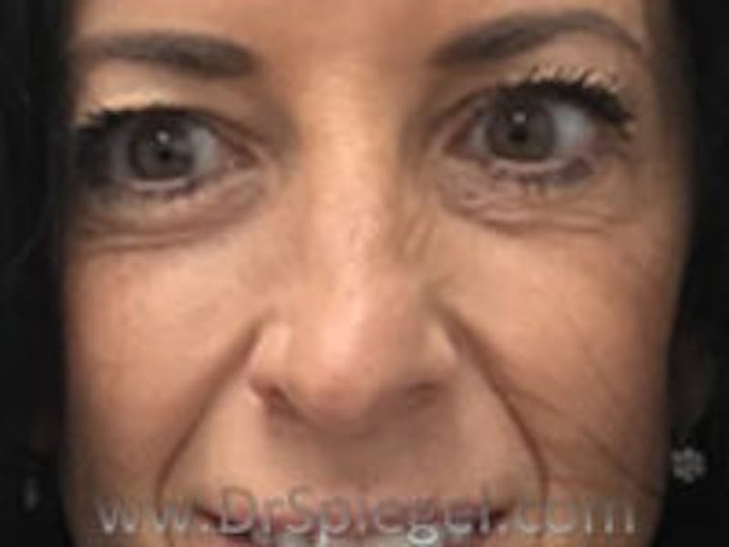 Non-Surgical Rhinoplasty / Nose Filler Before & After Gallery - Patient 232034 - Image 1