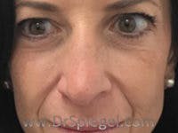 Non-Surgical Rhinoplasty / Nose Filler Before & After Gallery - Patient 232034 - Image 2