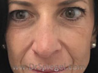 Non-Surgical Rhinoplasty / Nose Filler Before & After Gallery - Patient 232034 - Image 2