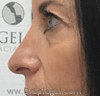 Non-Surgical Rhinoplasty / Nose Filler Before & After Gallery - Patient 232034 - Image 4